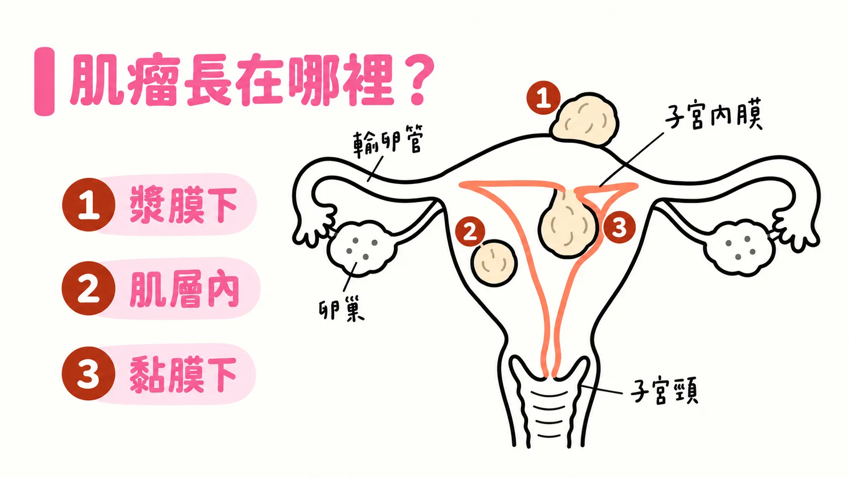 子宮肌瘤三種生長位置示意圖：1 漿膜下長在子宮最外側往外突出、2 肌層內完全埋在子宮肌肉層裡、3 黏膜下往子宮腔內突出